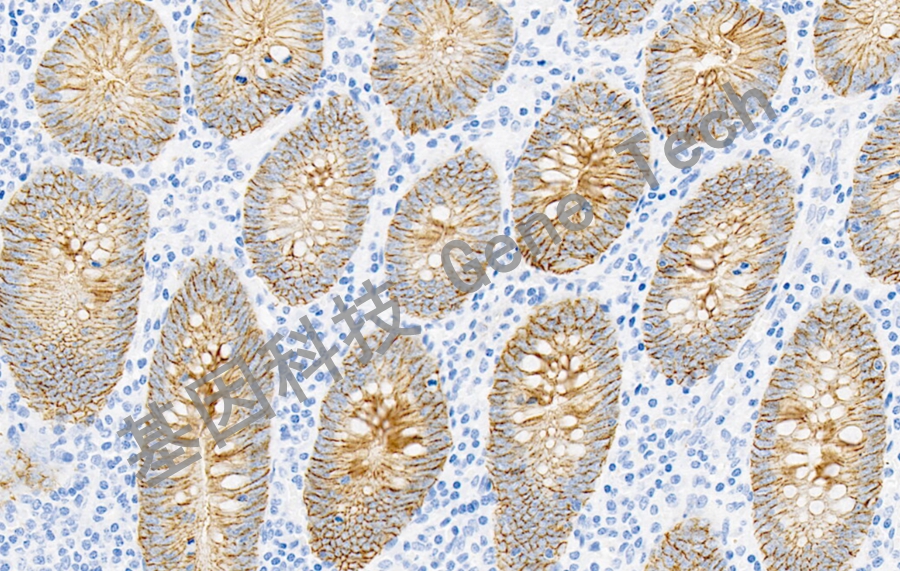 Claudin 4&GT2339-结肠癌-20X-细胞膜_副本.jpg