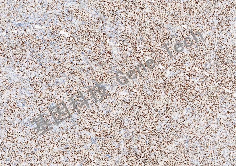 1772451107191097.jpg MEF2B-弥漫性大B细胞淋巴瘤_副本.jpg