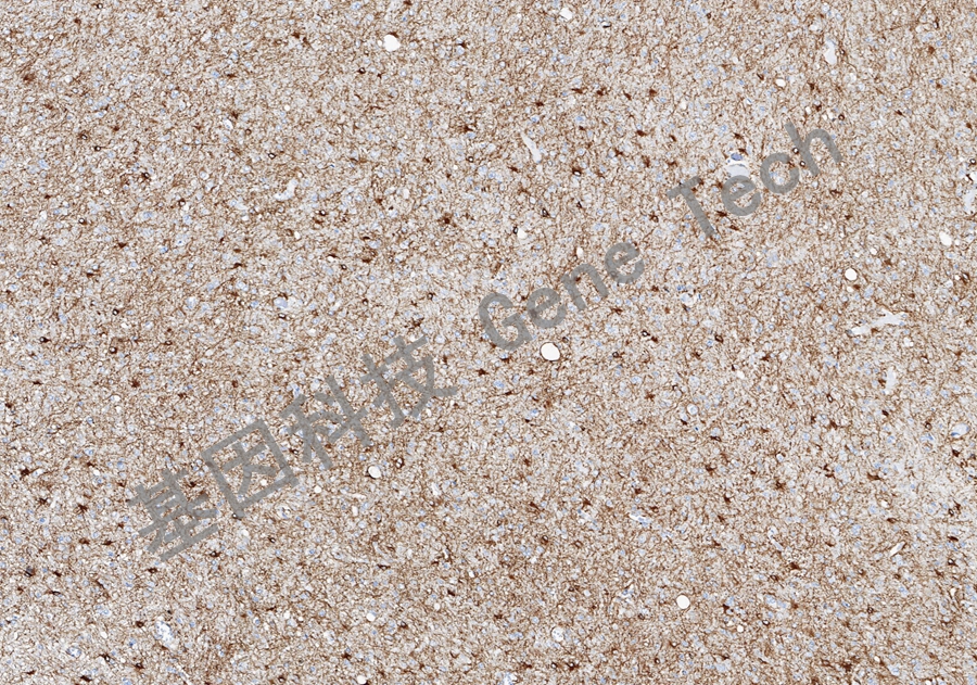 1772451529485422.jpg SPARC-脑胶质瘤_副本.jpg