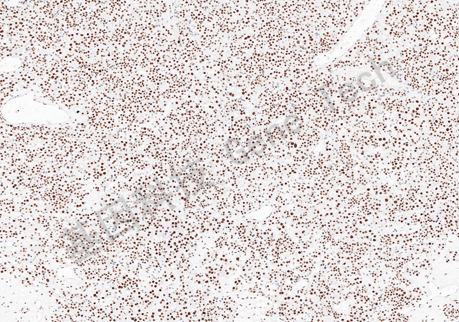 1780873410934243.jpg CDC73-甲状旁腺_副本.jpg