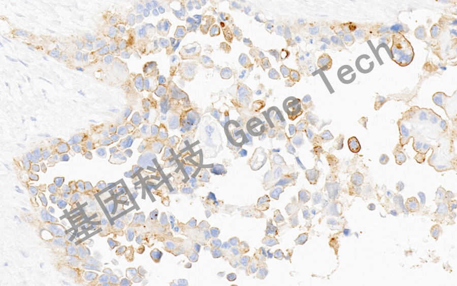 Mesothelin&GT2291-間皮瘤-20X-細胞膜+_副本.jpg
