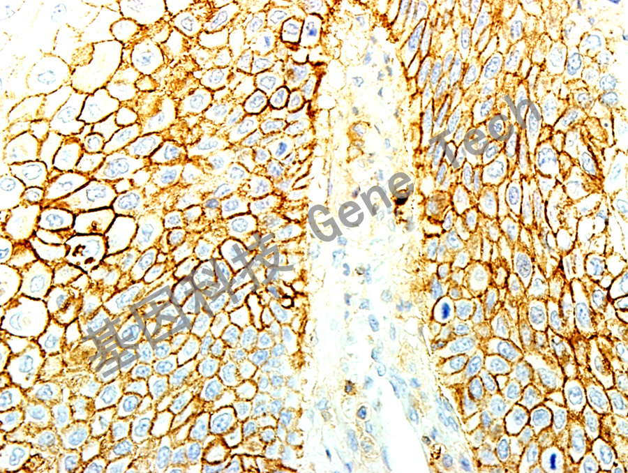 CD44&GM7082-食管癌-40X_副本.jpg