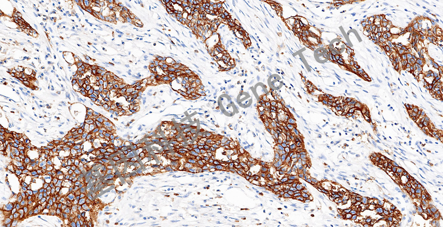 CD44V6&GT20200-肺腺癌-20X--2_副本.jpg