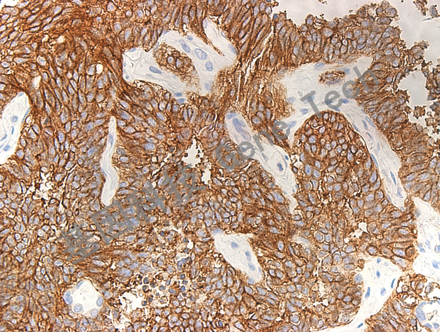 CD56&GT2005-肺小细胞癌-20X-细胞膜_副本.jpg