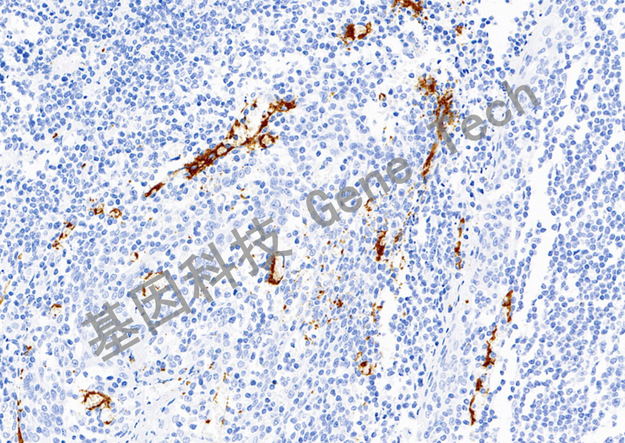 CD61&GT2141-扁桃体-20X-细胞浆_副本.jpg