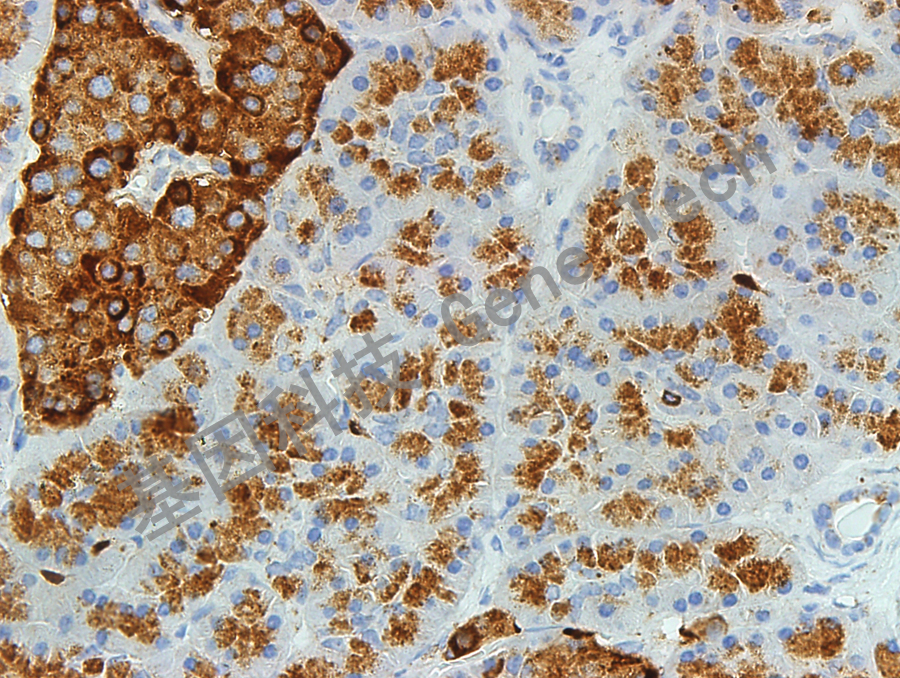 CD63 GT2142 胰腺癌 40X_副本.jpg