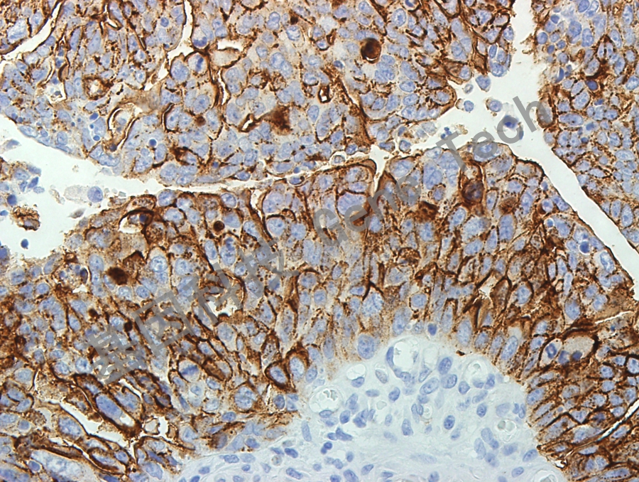 CA125 GT2028 卵巢浆液性腺癌_副本.jpg