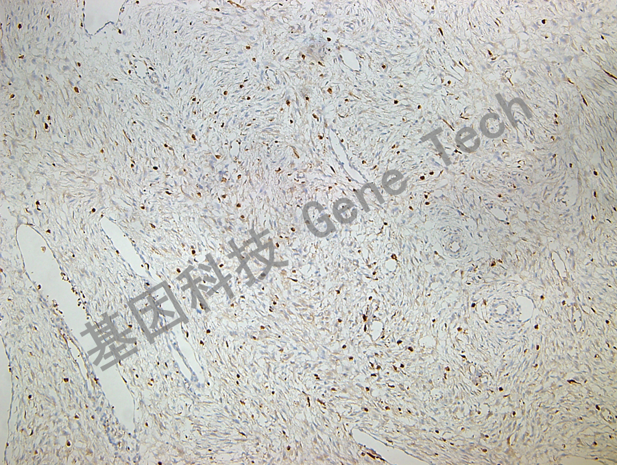 ALDH1A1 GT2216 纤维瘤 10X_副本.jpg