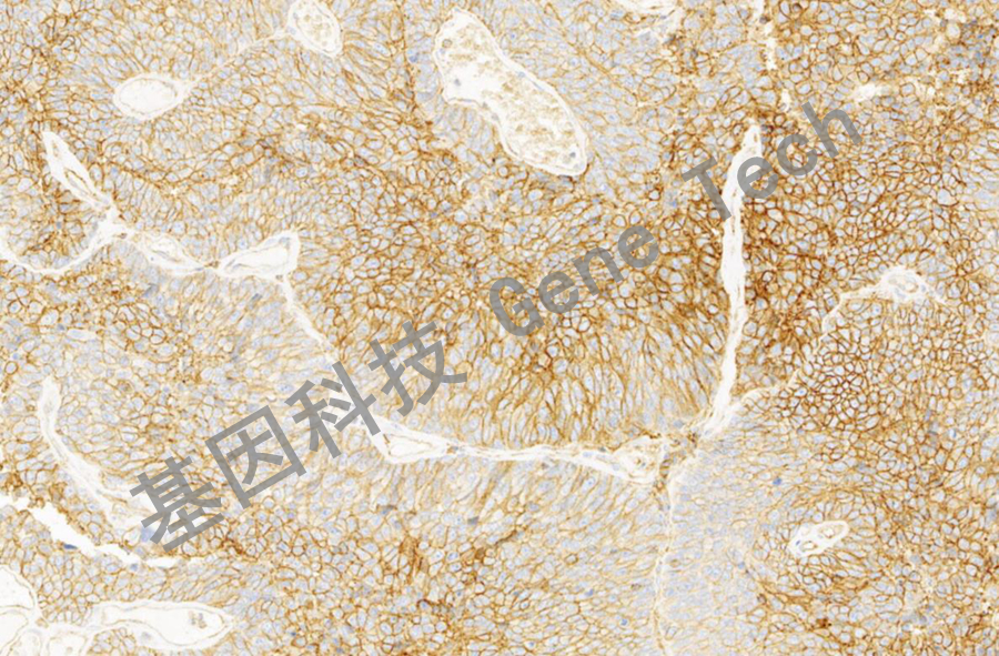 CD147&GT2334- 鳞状细胞癌-10X-细胞膜_副本.jpg
