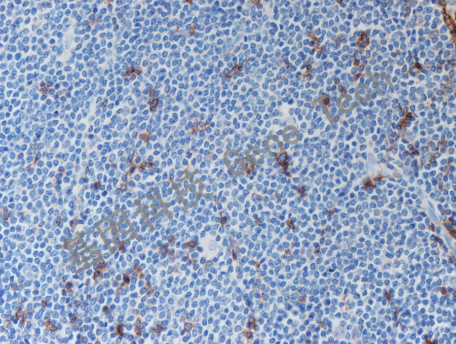 CD247&GT2442-间变性大细胞淋巴瘤-10X_副本.jpg