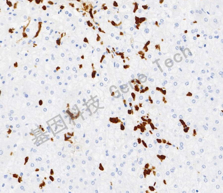 1772759667246761.jpg MHA>2371-肝癌_副本.jpg