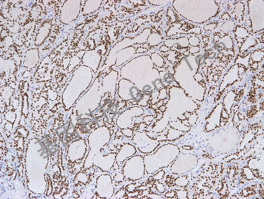 1773456195811231.jpg TTF-1 GT2180 甲状腺乳头状癌_副本.jpg