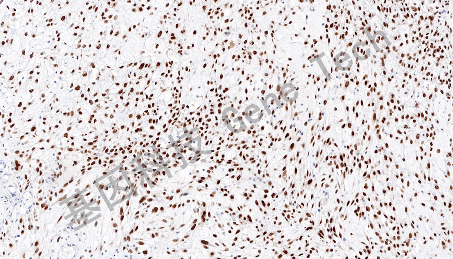 1773483608128493.jpg RUNX2-骨肉瘤_副本.jpg